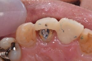 審美治療　審美歯科　インプラント　歯を残す治療　抜かない治療　セラミック
